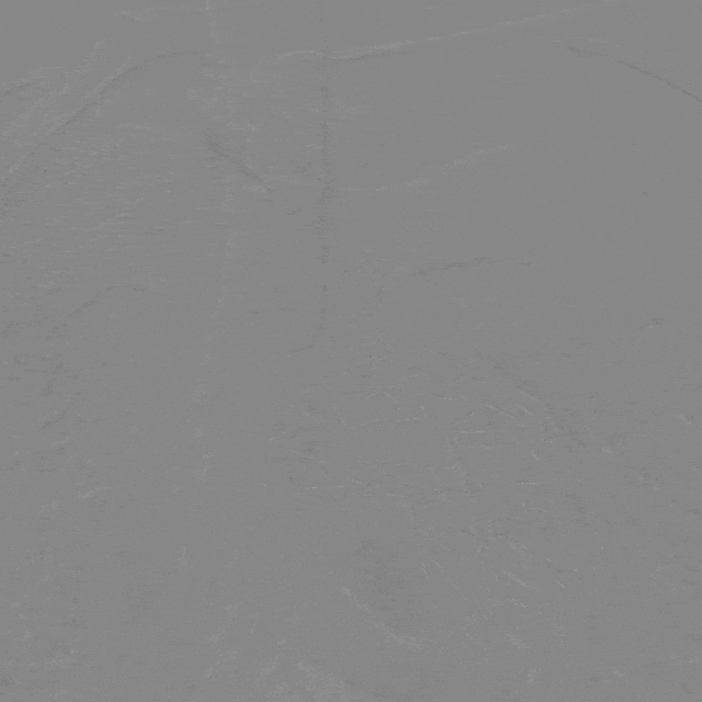 泥鳅导丝怎么用曲乐丰教授团队：0.018＂和0.035＂普通泥鳅导丝行胸主动脉弓上分支原位开窗的病例分享_https://www.jmylbn.com_新闻资讯_第41张