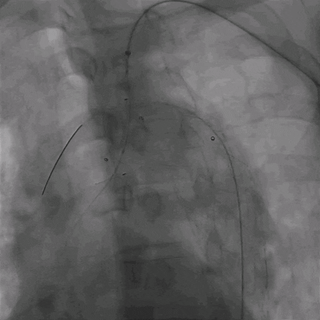 泥鳅导丝怎么用曲乐丰教授团队：0.018＂和0.035＂普通泥鳅导丝行胸主动脉弓上分支原位开窗的病例分享_https://www.jmylbn.com_新闻资讯_第36张