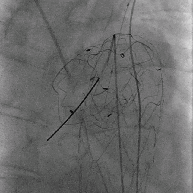 泥鳅导丝怎么用曲乐丰教授团队：0.018＂和0.035＂普通泥鳅导丝行胸主动脉弓上分支原位开窗的病例分享_https://www.jmylbn.com_新闻资讯_第14张