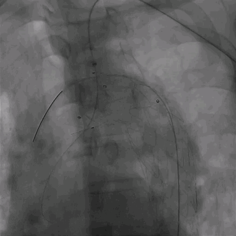 泥鳅导丝怎么用曲乐丰教授团队：0.018＂和0.035＂普通泥鳅导丝行胸主动脉弓上分支原位开窗的病例分享_https://www.jmylbn.com_新闻资讯_第37张