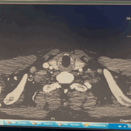 泥鳅导丝怎么用曲乐丰教授团队：0.018＂和0.035＂普通泥鳅导丝行胸主动脉弓上分支原位开窗的病例分享_https://www.jmylbn.com_新闻资讯_第23张