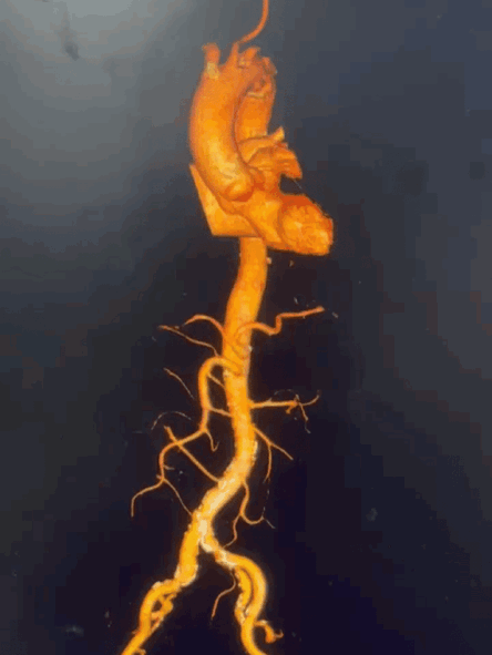 泥鳅导丝怎么用曲乐丰教授团队：0.018＂和0.035＂普通泥鳅导丝行胸主动脉弓上分支原位开窗的病例分享_https://www.jmylbn.com_新闻资讯_第3张