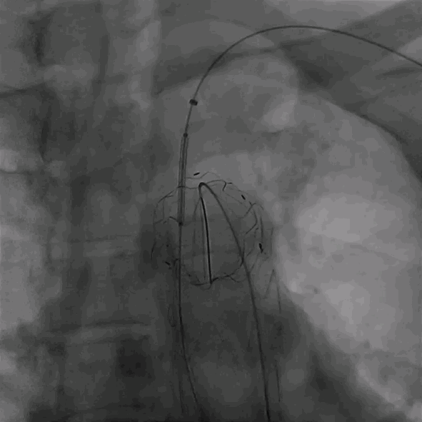 泥鳅导丝怎么用曲乐丰教授团队：0.018＂和0.035＂普通泥鳅导丝行胸主动脉弓上分支原位开窗的病例分享_https://www.jmylbn.com_新闻资讯_第39张