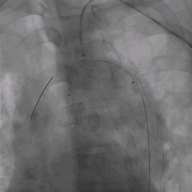 泥鳅导丝怎么用曲乐丰教授团队：0.018＂和0.035＂普通泥鳅导丝行胸主动脉弓上分支原位开窗的病例分享_https://www.jmylbn.com_新闻资讯_第32张