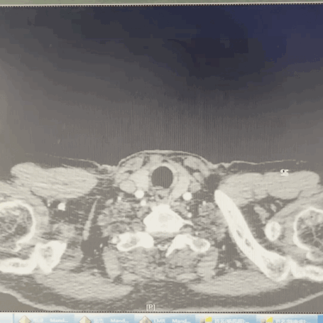 泥鳅导丝怎么用曲乐丰教授团队：0.018＂和0.035＂普通泥鳅导丝行胸主动脉弓上分支原位开窗的病例分享_https://www.jmylbn.com_新闻资讯_第4张