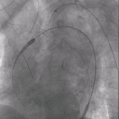泥鳅导丝怎么用曲乐丰教授团队：0.018＂和0.035＂普通泥鳅导丝行胸主动脉弓上分支原位开窗的病例分享_https://www.jmylbn.com_新闻资讯_第11张