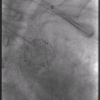 泥鳅导丝怎么用曲乐丰教授团队：0.018＂和0.035＂普通泥鳅导丝行胸主动脉弓上分支原位开窗的病例分享_https://www.jmylbn.com_新闻资讯_第16张