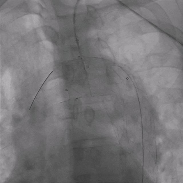 泥鳅导丝怎么用曲乐丰教授团队：0.018＂和0.035＂普通泥鳅导丝行胸主动脉弓上分支原位开窗的病例分享_https://www.jmylbn.com_新闻资讯_第33张