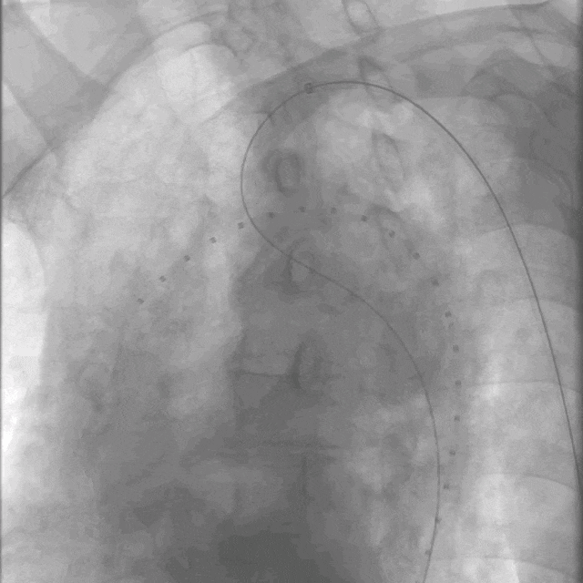泥鳅导丝怎么用曲乐丰教授团队：0.018＂和0.035＂普通泥鳅导丝行胸主动脉弓上分支原位开窗的病例分享_https://www.jmylbn.com_新闻资讯_第8张
