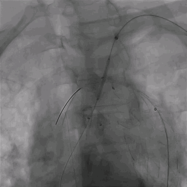 泥鳅导丝怎么用曲乐丰教授团队：0.018＂和0.035＂普通泥鳅导丝行胸主动脉弓上分支原位开窗的病例分享_https://www.jmylbn.com_新闻资讯_第40张