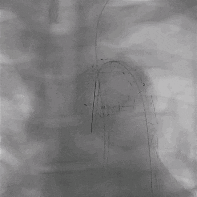 泥鳅导丝怎么用曲乐丰教授团队：0.018＂和0.035＂普通泥鳅导丝行胸主动脉弓上分支原位开窗的病例分享_https://www.jmylbn.com_新闻资讯_第38张