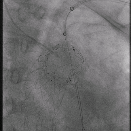 泥鳅导丝怎么用曲乐丰教授团队：0.018＂和0.035＂普通泥鳅导丝行胸主动脉弓上分支原位开窗的病例分享_https://www.jmylbn.com_新闻资讯_第17张
