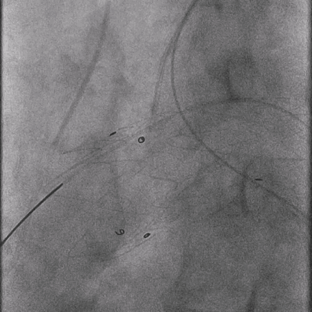 泥鳅导丝怎么用曲乐丰教授团队：0.018＂和0.035＂普通泥鳅导丝行胸主动脉弓上分支原位开窗的病例分享_https://www.jmylbn.com_新闻资讯_第13张