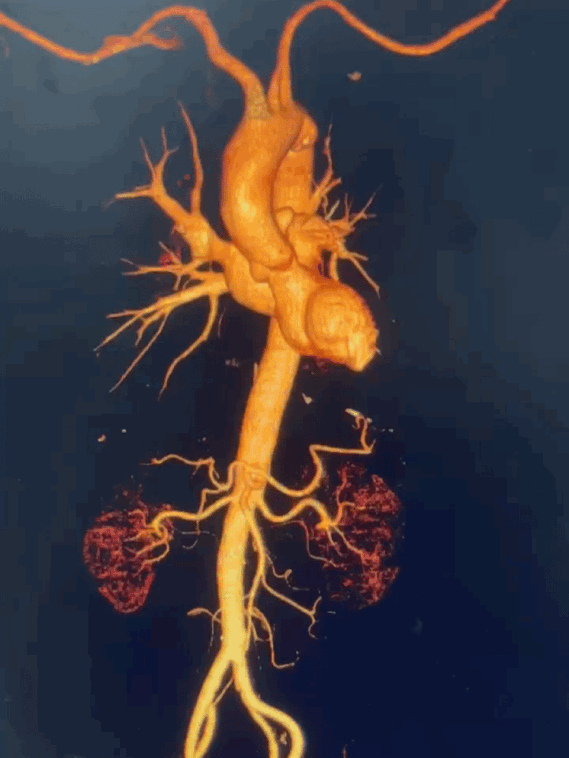 泥鳅导丝怎么用曲乐丰教授团队：0.018＂和0.035＂普通泥鳅导丝行胸主动脉弓上分支原位开窗的病例分享_https://www.jmylbn.com_新闻资讯_第22张