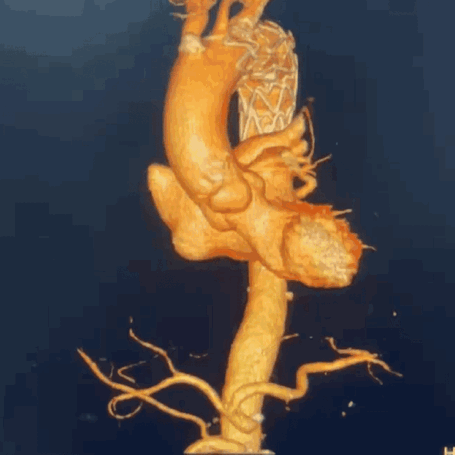 泥鳅导丝怎么用曲乐丰教授团队：0.018＂和0.035＂普通泥鳅导丝行胸主动脉弓上分支原位开窗的病例分享_https://www.jmylbn.com_新闻资讯_第20张