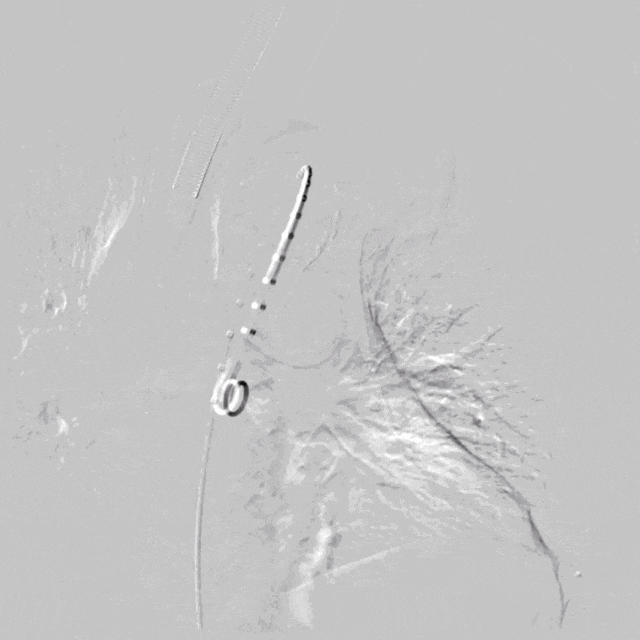 泥鳅导丝怎么用符伟国／王利新教授团队：0.035＂普通泥鳅导丝进行胸主动脉弓上分支原位开窗的病例分享_https://www.jmylbn.com_新闻资讯_第9张