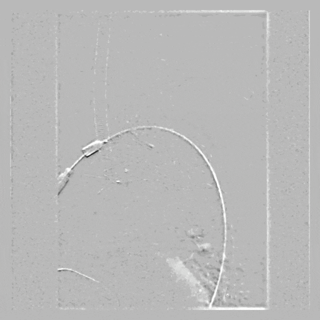 泥鳅导丝怎么用符伟国／王利新教授团队：0.035＂普通泥鳅导丝进行胸主动脉弓上分支原位开窗的病例分享_https://www.jmylbn.com_新闻资讯_第16张
