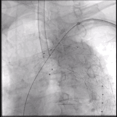 泥鳅导丝怎么用符伟国／王利新教授团队：0.035＂普通泥鳅导丝进行胸主动脉弓上分支原位开窗的病例分享_https://www.jmylbn.com_新闻资讯_第21张