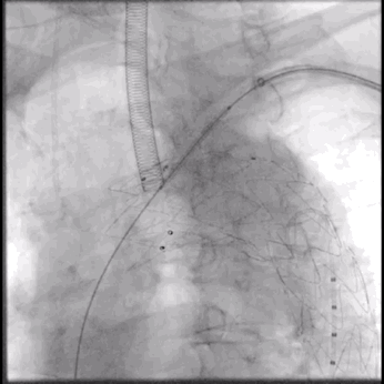 泥鳅导丝怎么用符伟国／王利新教授团队：0.035＂普通泥鳅导丝进行胸主动脉弓上分支原位开窗的病例分享_https://www.jmylbn.com_新闻资讯_第20张