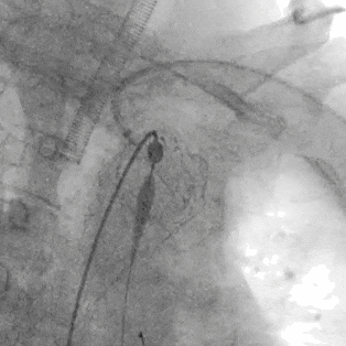 泥鳅导丝怎么用符伟国／王利新教授团队：0.035＂普通泥鳅导丝进行胸主动脉弓上分支原位开窗的病例分享_https://www.jmylbn.com_新闻资讯_第15张