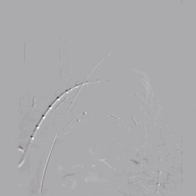 泥鳅导丝怎么用符伟国／王利新教授团队：0.035＂普通泥鳅导丝进行胸主动脉弓上分支原位开窗的病例分享_https://www.jmylbn.com_新闻资讯_第24张