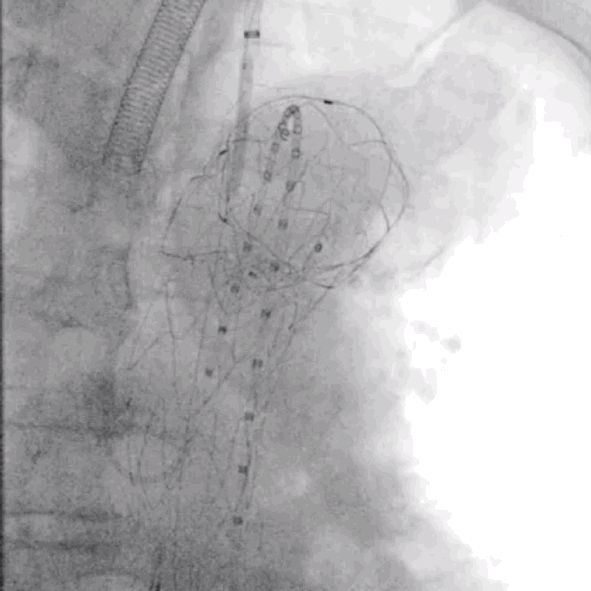 泥鳅导丝怎么用符伟国／王利新教授团队：0.035＂普通泥鳅导丝进行胸主动脉弓上分支原位开窗的病例分享_https://www.jmylbn.com_新闻资讯_第17张
