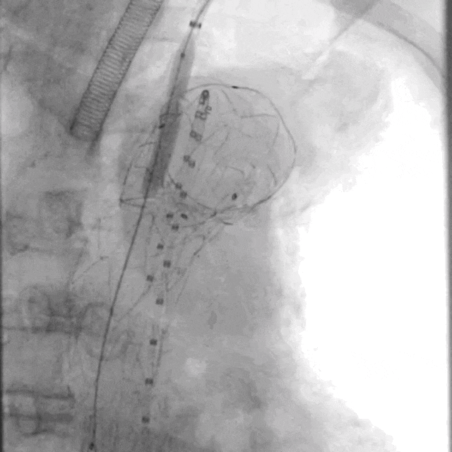 泥鳅导丝怎么用符伟国／王利新教授团队：0.035＂普通泥鳅导丝进行胸主动脉弓上分支原位开窗的病例分享_https://www.jmylbn.com_新闻资讯_第18张