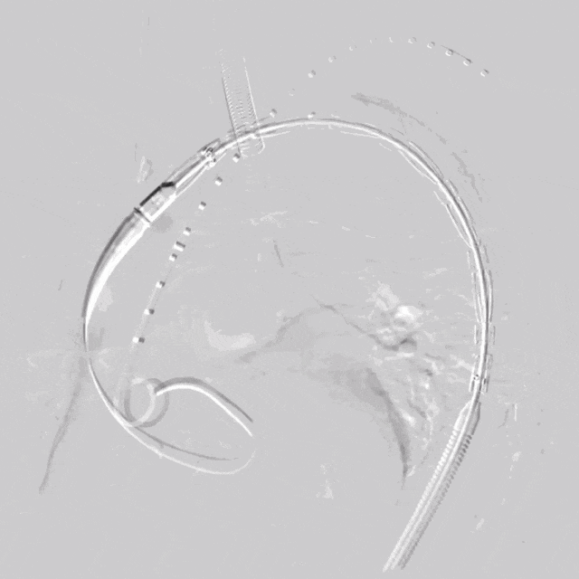 泥鳅导丝怎么用符伟国／王利新教授团队：0.035＂普通泥鳅导丝进行胸主动脉弓上分支原位开窗的病例分享_https://www.jmylbn.com_新闻资讯_第10张