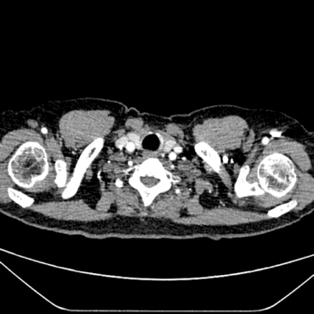 泥鳅导丝怎么用符伟国／王利新教授团队：0.035＂普通泥鳅导丝进行胸主动脉弓上分支原位开窗的病例分享_https://www.jmylbn.com_新闻资讯_第30张