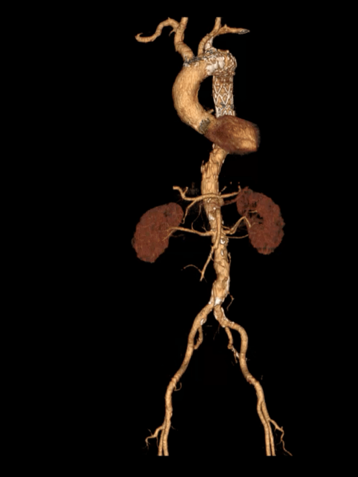 泥鳅导丝怎么用符伟国／王利新教授团队：0.035＂普通泥鳅导丝进行胸主动脉弓上分支原位开窗的病例分享_https://www.jmylbn.com_新闻资讯_第29张