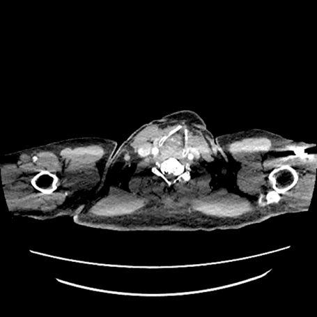 泥鳅导丝怎么用符伟国／王利新教授团队：0.035＂普通泥鳅导丝进行胸主动脉弓上分支原位开窗的病例分享_https://www.jmylbn.com_新闻资讯_第4张