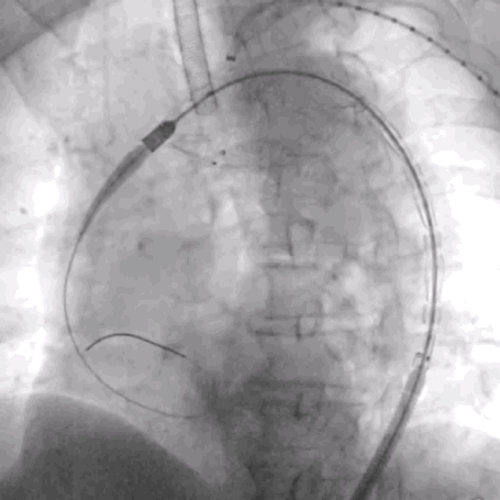 泥鳅导丝怎么用符伟国／王利新教授团队：0.035＂普通泥鳅导丝进行胸主动脉弓上分支原位开窗的病例分享_https://www.jmylbn.com_新闻资讯_第11张