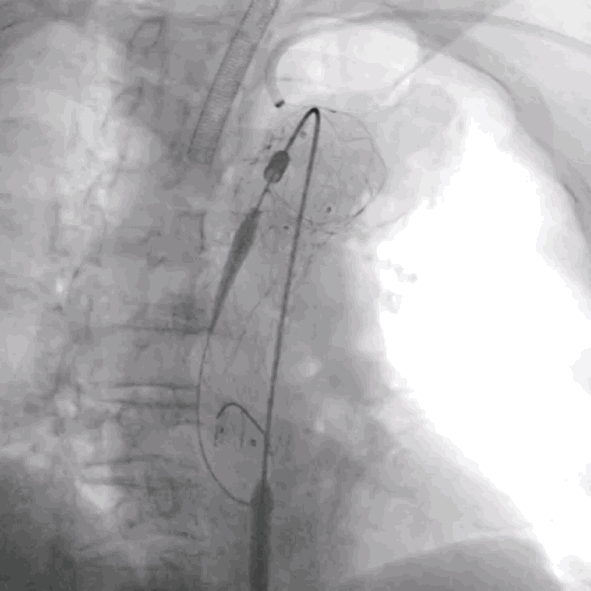 泥鳅导丝怎么用符伟国／王利新教授团队：0.035＂普通泥鳅导丝进行胸主动脉弓上分支原位开窗的病例分享_https://www.jmylbn.com_新闻资讯_第14张