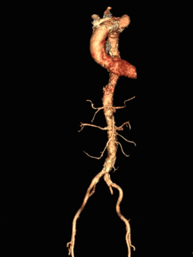 泥鳅导丝怎么用符伟国／王利新教授团队：0.035＂普通泥鳅导丝进行胸主动脉弓上分支原位开窗的病例分享_https://www.jmylbn.com_新闻资讯_第3张