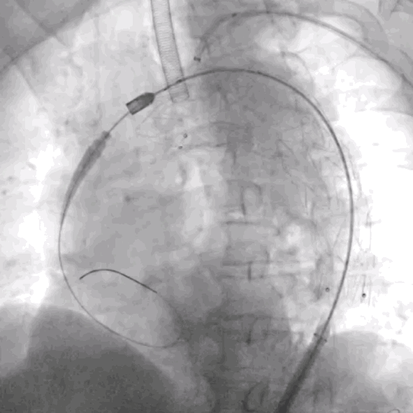 泥鳅导丝怎么用符伟国／王利新教授团队：0.035＂普通泥鳅导丝进行胸主动脉弓上分支原位开窗的病例分享_https://www.jmylbn.com_新闻资讯_第13张