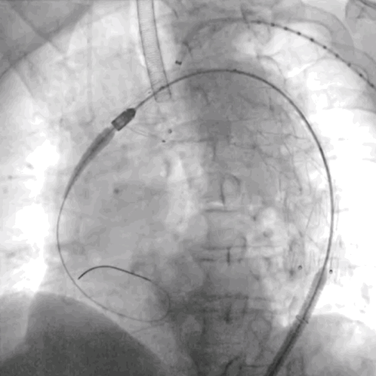泥鳅导丝怎么用符伟国／王利新教授团队：0.035＂普通泥鳅导丝进行胸主动脉弓上分支原位开窗的病例分享_https://www.jmylbn.com_新闻资讯_第12张