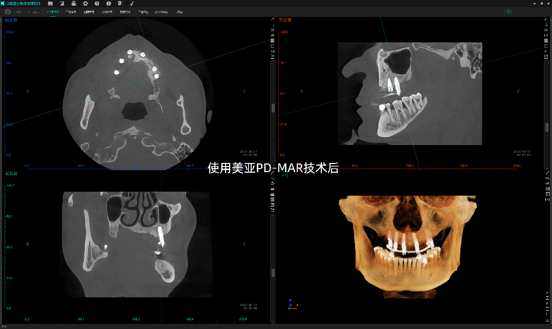 再度攻克行业难题!去伪存真,只有美亚口腔cbct!