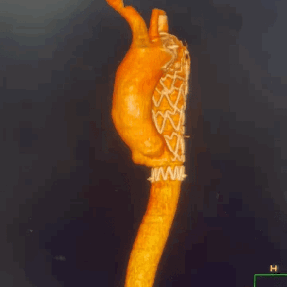 泥鳅导丝怎么用曲乐丰教授团队：0.018＂和0.035＂普通泥鳅导丝行胸主动脉弓上分支原位开窗的病例分享_https://www.jmylbn.com_新闻资讯_第43张