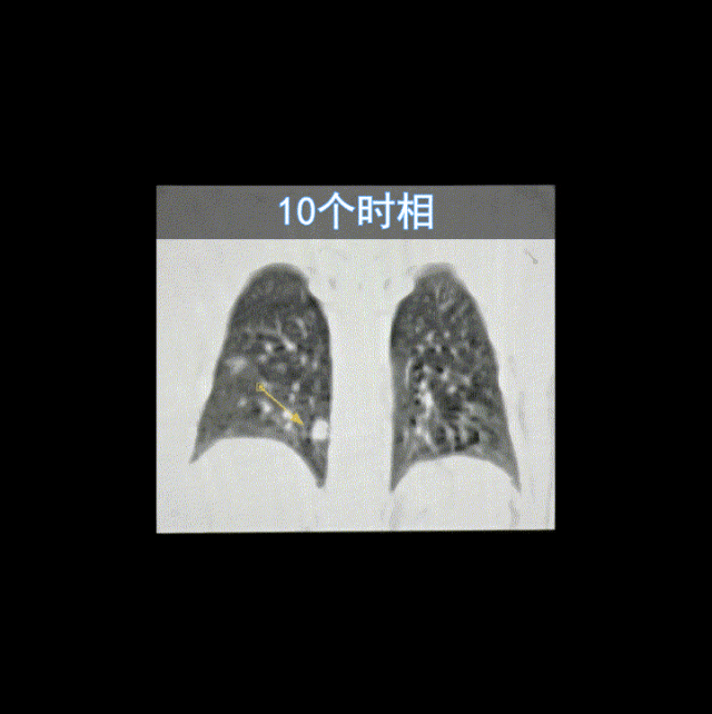 ct机器怎么分辨【科普】四维CT图像：如何助力精准放疗？_https://www.jmylbn.com_新闻资讯_第11张