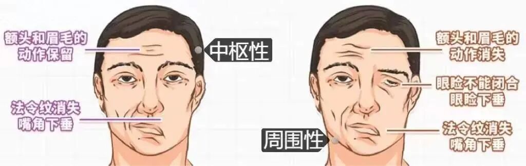 疼痛科怎么理疗面瘫针灸理疗都没用？疼痛科医生15分钟射频治疗，让瘫痪的脸“活”过来！_https://www.jmylbn.com_新闻资讯_第4张