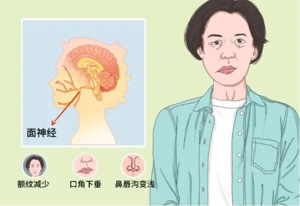 疼痛科怎么理疗面瘫针灸理疗都没用？疼痛科医生15分钟射频治疗，让瘫痪的脸“活”过来！_https://www.jmylbn.com_新闻资讯_第5张