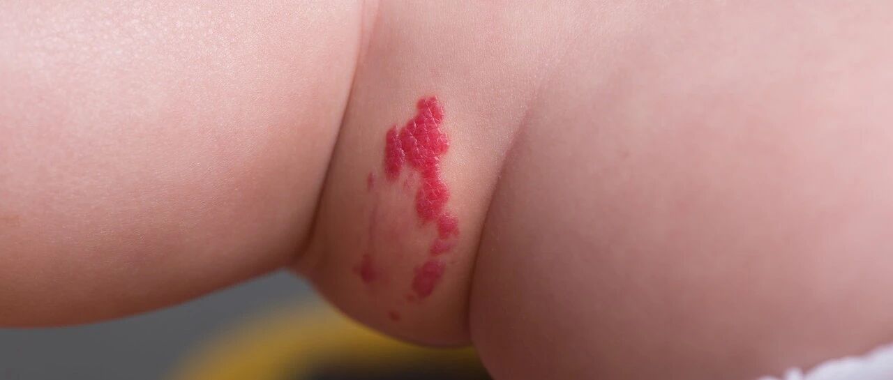 "胎记"也分好坏？长这样的可能恶变，一定要注意！