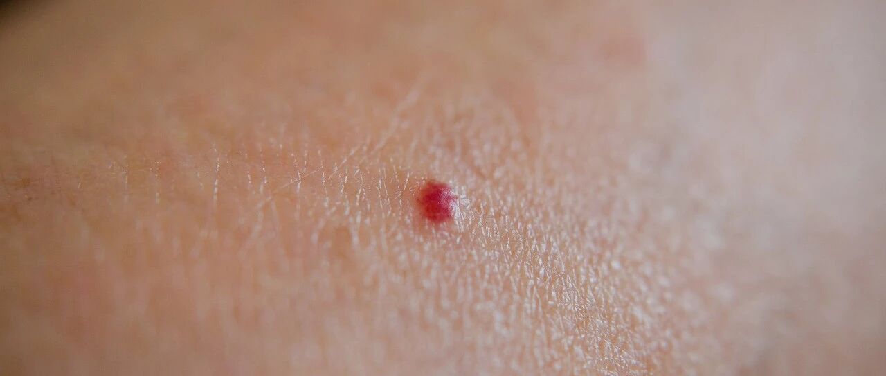 千万别大意！身上有这种小红痣，很可能是大病的预警信号…