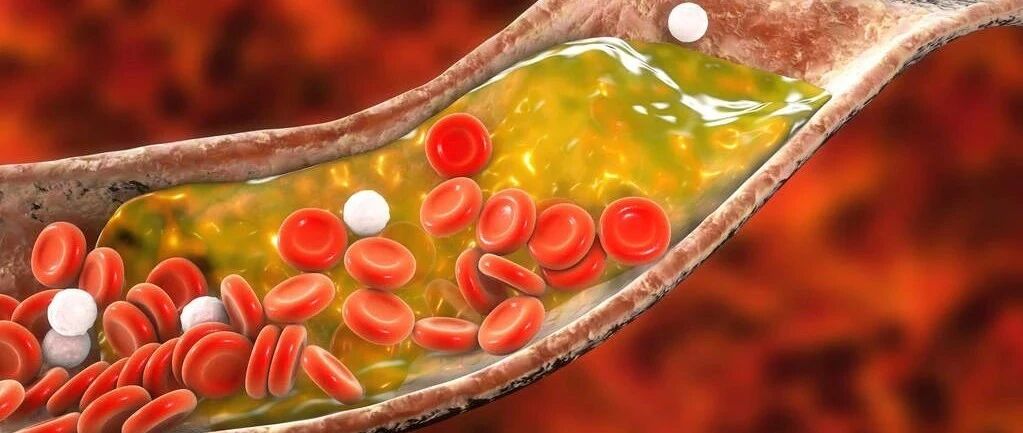 警惕！60岁以上，几乎人人都有颈动脉斑块，出现这三个症状最危险！