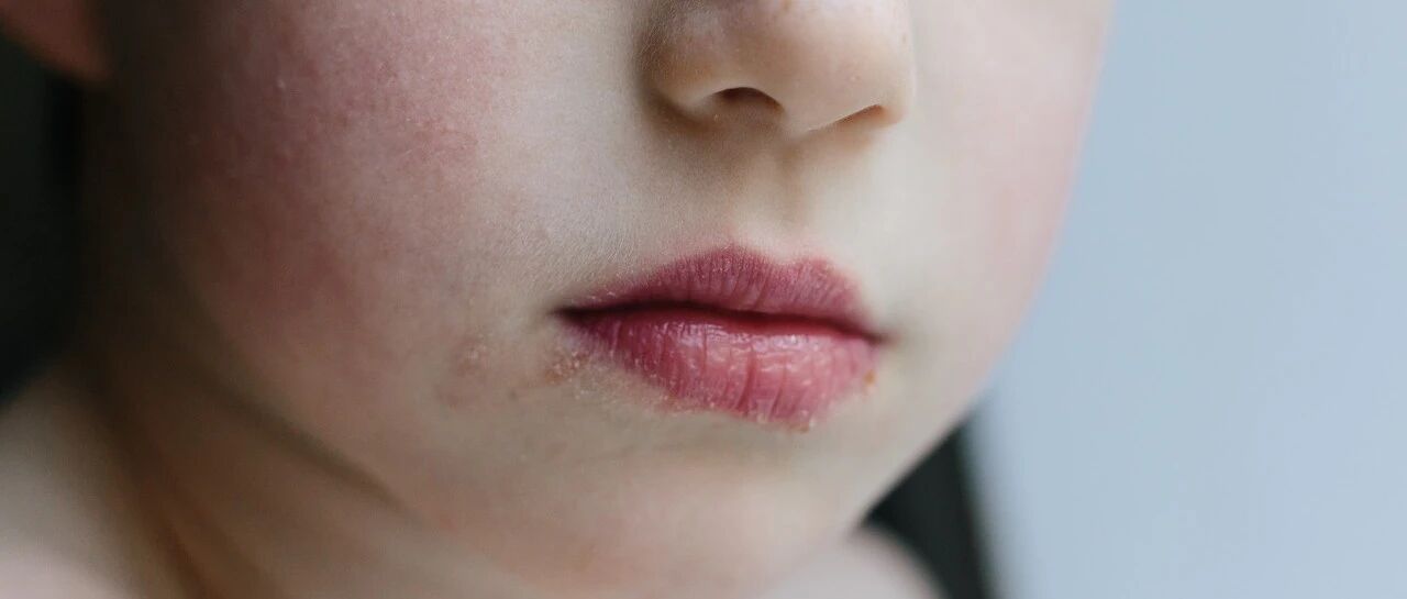 "烂嘴角"到底是个什么病？ 别不当回事！长期不治会增加患癌风险