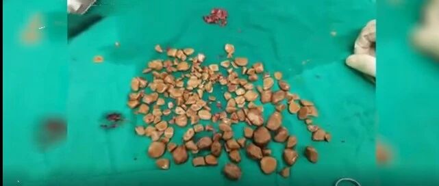 密密麻麻！膀胱里竟取出近200颗石子！医生：男性更危险！都是这些习惯惹的祸…