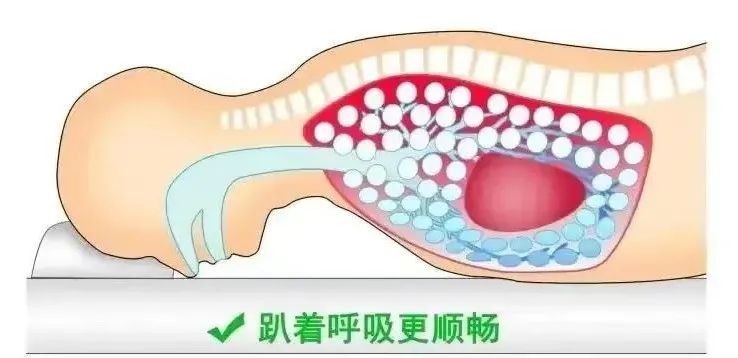 新生儿俯卧位通气图片图片