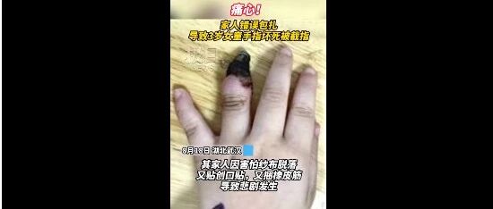 家人错误包扎致3岁女童手指坏死！注意，这些情况下创口贴不可用…