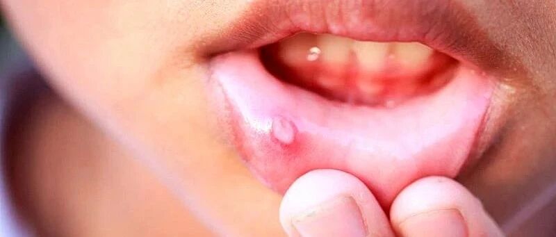 无法根治！口腔溃疡反复发作？超过这个时间，当心癌症找上门…