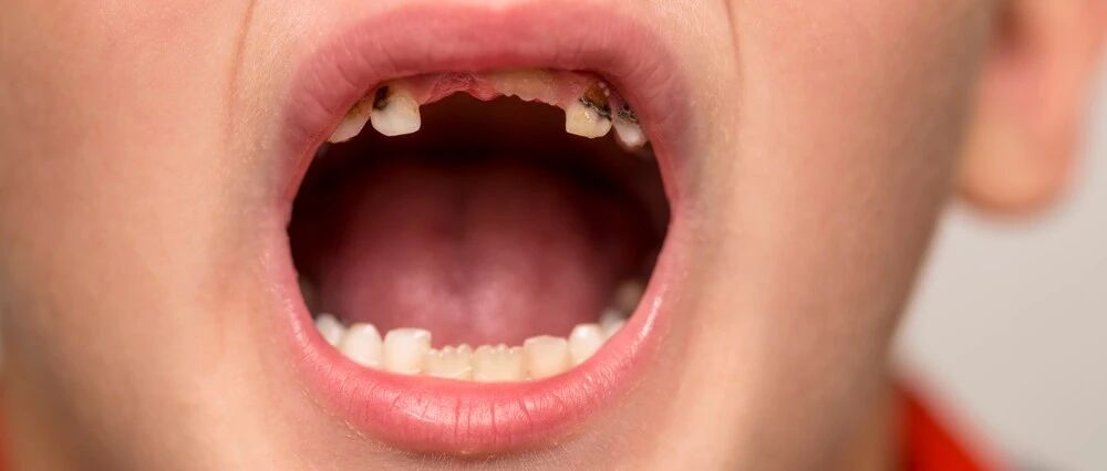 不好好护牙，后果很严重！从出生到成年如何护牙，口腔科医生全都告诉你！